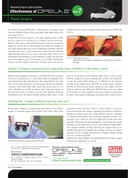 Case study N°7 Effectiveness of OPELAIII in Plastic Surgery