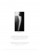 CORAIL® Hip System Design Rationale