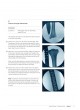 Expert Tibia Nail