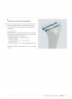 Expert Tibia Nail
