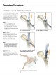 Gamma3 U-Blade Lag Screw оптом