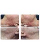 Аппарат для микроукалывания Dermapen® оптом