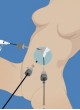 Хирургический сачок для извлечения для лапароскопической хирургии TBI1031 оптом