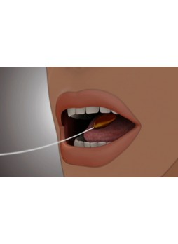 Нехирургический внутрижелудочный баллон Elipse™