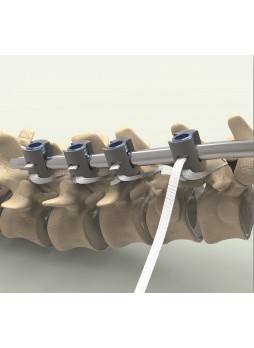 Спинномозговое крепление для задней фиксации Ortholox® UHMWPE