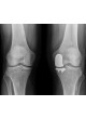Коленный протез с одним отсеком STRIDE™ оптом