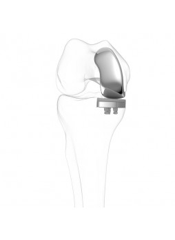 Коленный протез с одним отсеком iUni®