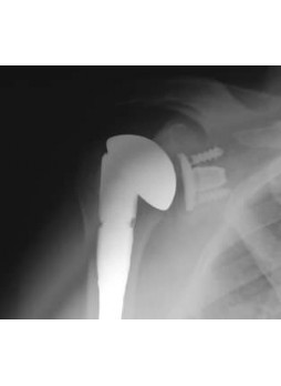 Восстановительный плечевой протез ANATOMIC