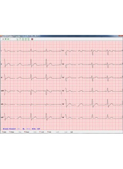 Модуль программного обеспечения для электрокардиографии ArMaSoft-12-Cardio