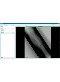 Модуль программного обеспечения для управления Fracture Management