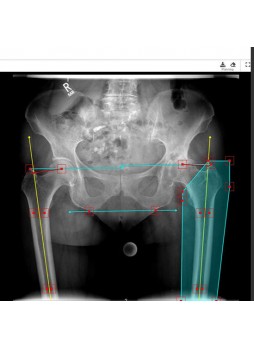 Модуль программного обеспечения для предоперационного планирования mediCAD Web