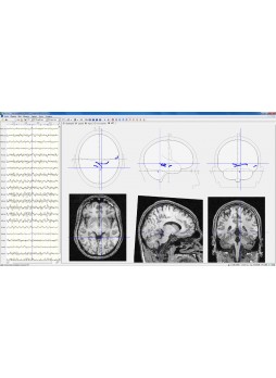 Программное обеспечение для ЭКГ BrainLoc 6.0