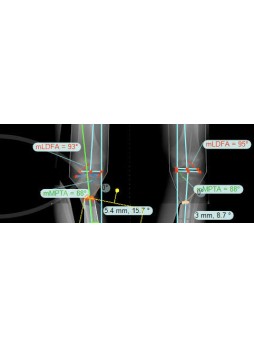 Программное обеспечение для хирургии тазобедренного сустава TraumaCad® HIP