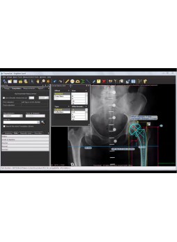 Программное обеспечение для хирургии тазобедренного сустава TraumaCad® HIP