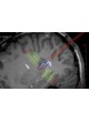 Программное обеспечение для медицинских снимков NeuroBlate ® SoftwareTM NeuroBlate ® оптом