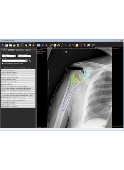 Программное обеспечение для ортопедической хирургии TraumaCad® UPPER LIMB