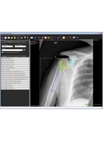 Программное обеспечение для ортопедической хирургии TraumaCad® UPPER LIMB