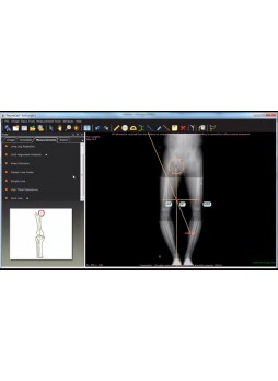 Программное обеспечение для предоперационного планирования TraumaCad® KNEE