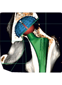 Программное обеспечение для ортопедической визуализации mediCAD 2D