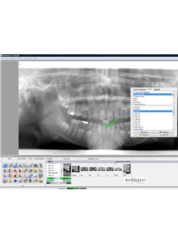 Программное обеспечение для моделирования зубного импланта Mediadent v6