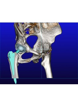Программное обеспечение TDM mediCAD 3D Hip