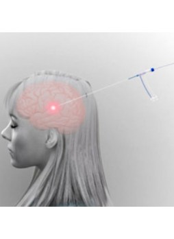 Устройство для лазерной абляции для лечения опухолей мозга Visualase™
