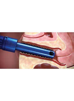 Лазер для гинекологической хирургии FemTouch™