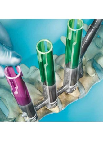 Мини-инвазивное устройство позиционирования транспедикулярного винта PHOENIX®