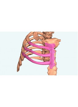 Грудной протез для восстановления после резекции остеосаркомы