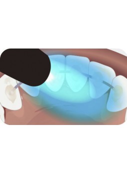 Ортодонтический стоматологический клей Connect™ Flow
