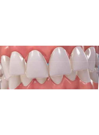 Зубная форма для выравнивания зубов Invisalign оптом