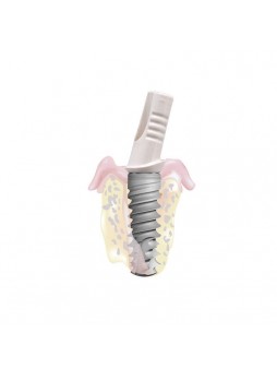 Цилиндрический конический зубной имплантат Shark Dental Implant