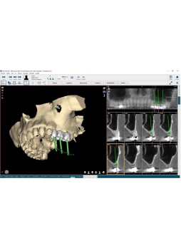 Программное обеспечение для стоматологической имплантологии NemoScan