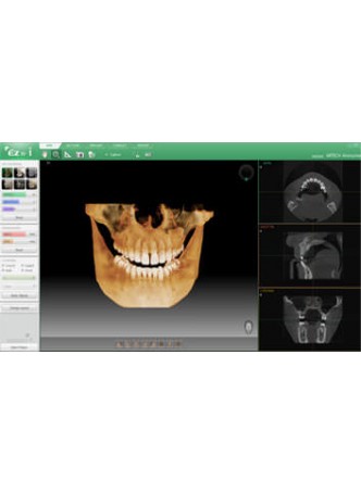 Программное обеспечение для стоматологии Ez3D-i