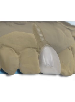 Стоматологический протез по индивидуальному заказу Custom
