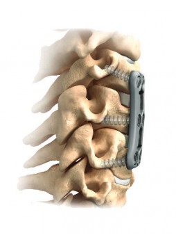 Шейная артродезная пластина ACDF