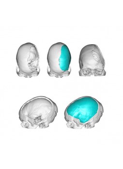 Черепной имплантат на заказ