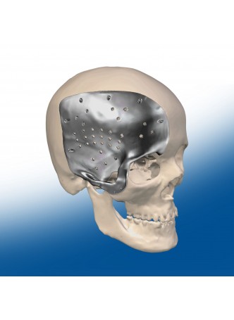 Черепной имплантат на заказ оптом