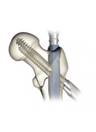 Интрамедуллярный штифт вертел TRIGEN™ INTERTAN