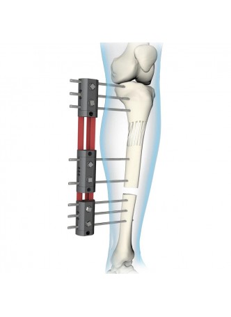 Внешний фиксатор большеберцовая кость Cromus оптом